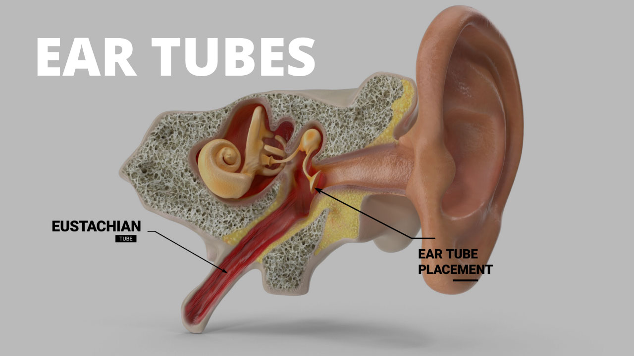 Ear Tubes From Capital Otolaryngology In Austin, TX
