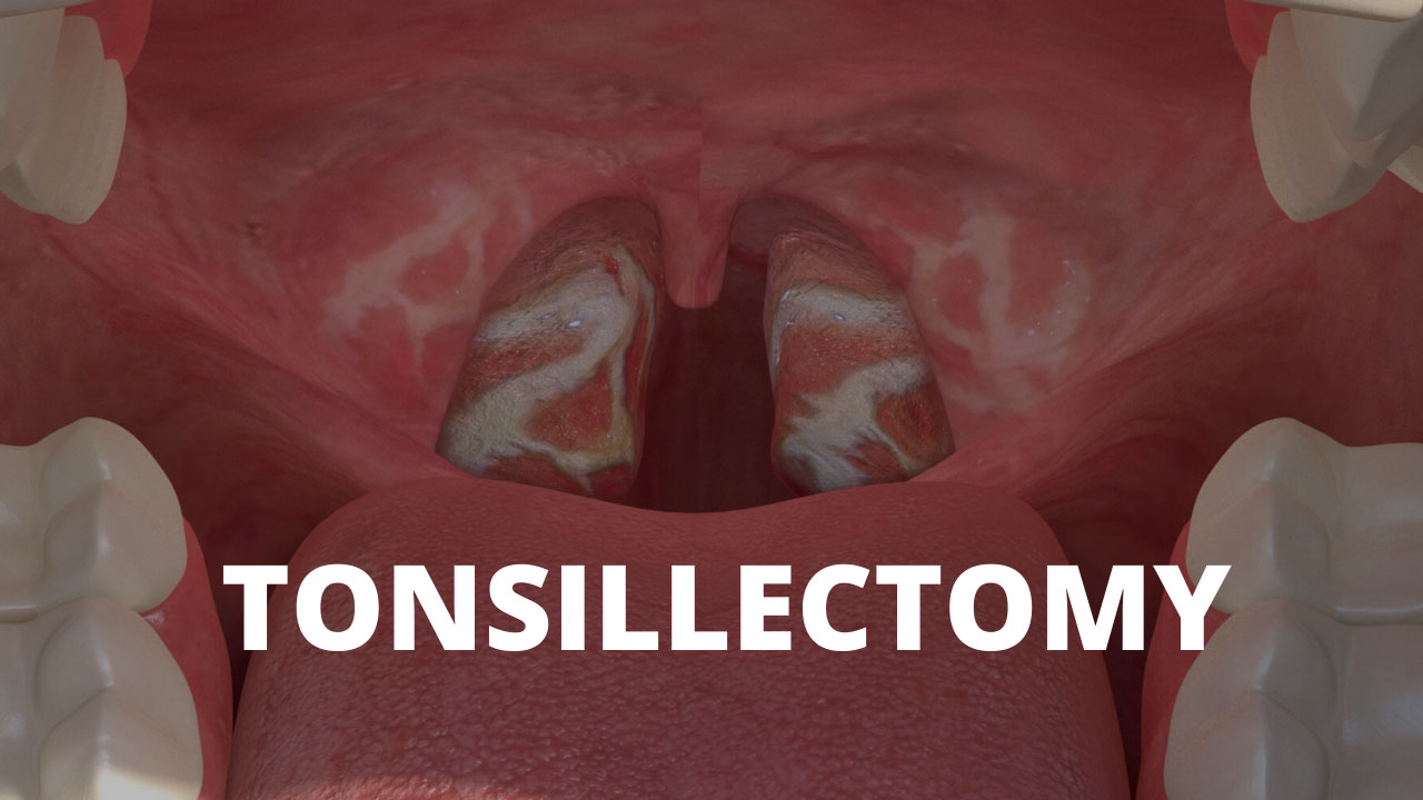 Tonsillectomy With Dr. Raymond Brown