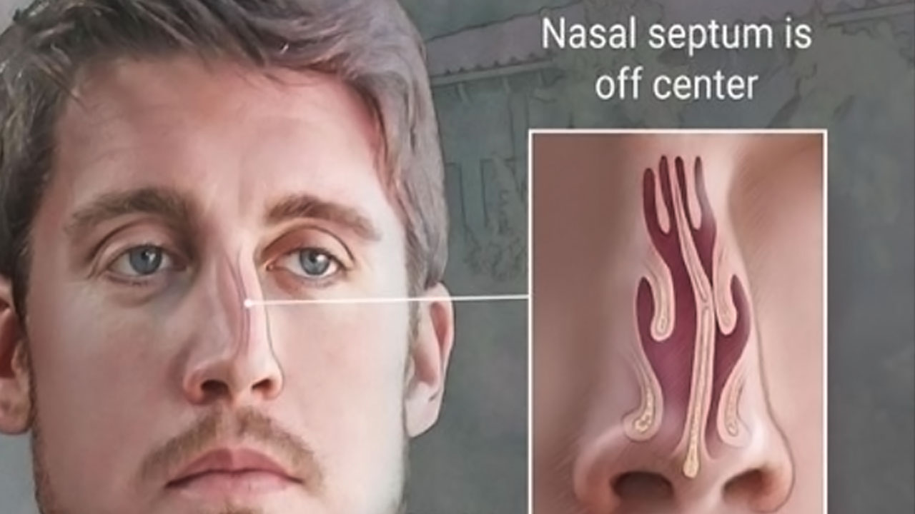 What Is Deviated Septum Surgery Ask The Ent Capital Otolaryngology